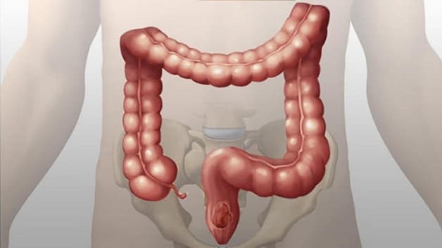 Viêm ruột già có nguy hiểm không? Bệnh nguy hiểm khi xảy ra các biến chứng 