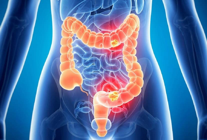 Giải đáp: “Bệnh viêm ruột già có nguy hiểm không?”