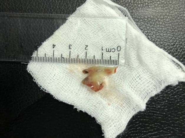 Xương cá có tan không