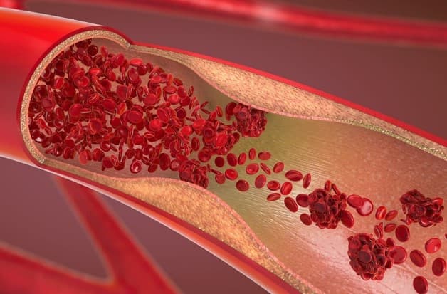 Bệnh mạch vành cấp