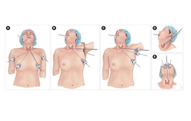 Cắt 2 thùy tuyến giáp cần được thực hiện bởi bác sĩ có kinh nghiệm