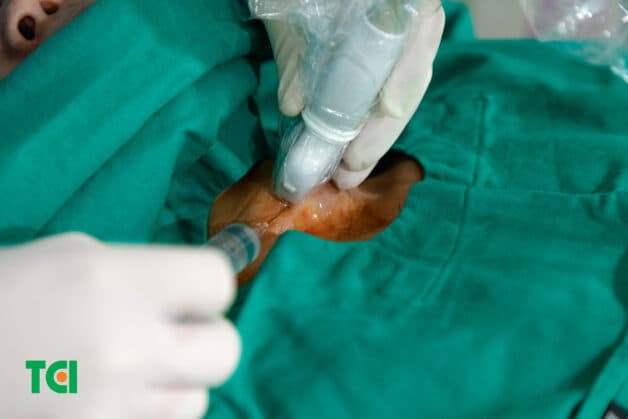 Loại bỏ khối u to như quả trứng vịt chỉ bằng mũi kim siêu nhỏ (Ảnh:TCI)