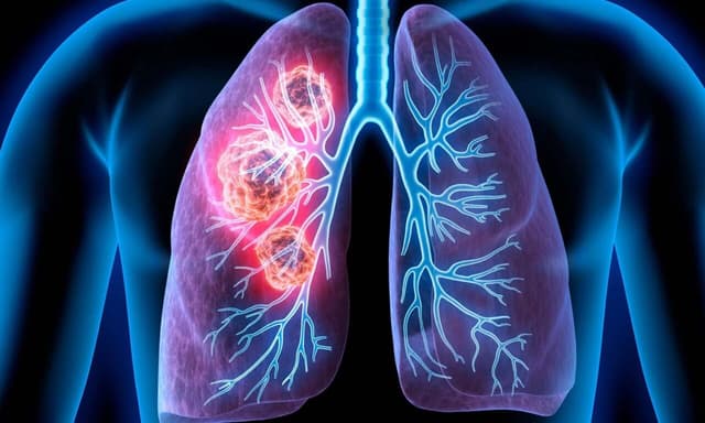 Giải đáp câu hỏi thường gặp về ung thư phổi di căn