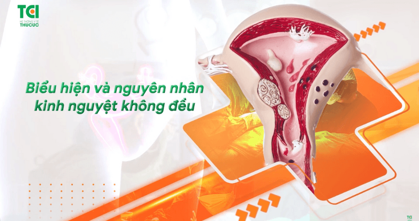 Kinh nguyệt không đều: Biểu hiện và nguyên nhân do đâu