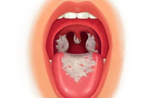 bệnh bạch hầu lây qua đường nào