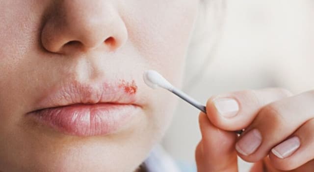 Bệnh herpes có chữa khỏi được không và cách chăm sóc