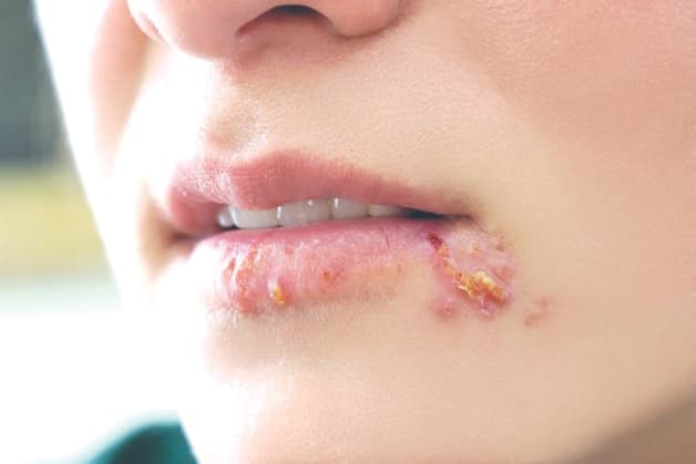 bệnh herpes có chữa khỏi được không