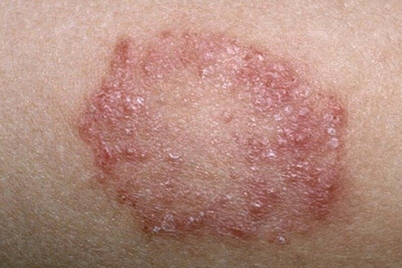 Giang mai có thể bị lây nhiễm qua đường tình dục, từ mẹ sang con