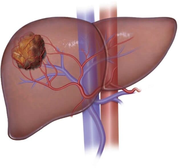 Điều trị ung thư gan biểu mô tế bào HCC giai đoạn 2