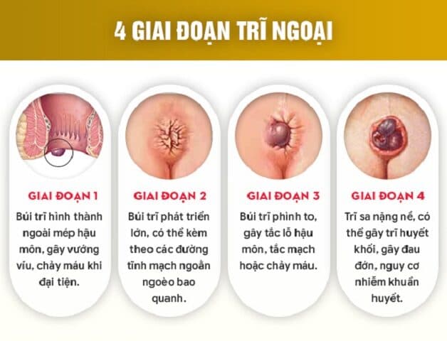 các cấp độ bệnh trĩ ngoại 