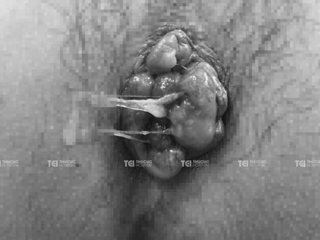 các loại bệnh trĩ