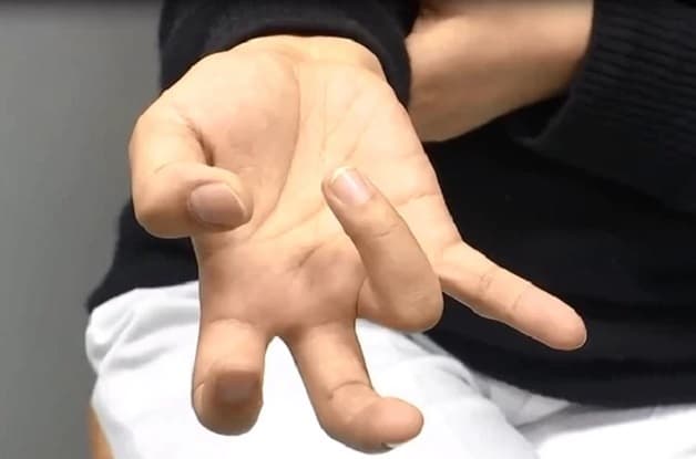 dấu hiệu co cứng cơ như thế nào?