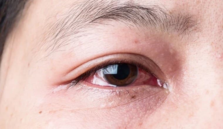 Bệnh đau mắt đỏ rất dễ lây lan trong cộng đồng thông qua dịch tiết có chứa virus của người bệnh