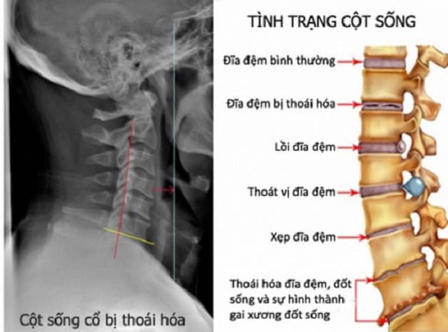 đau vai gáy do thoái hóa cột sống cổ là gì? 