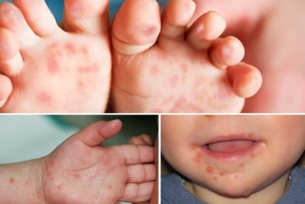 Nhiều dịch bệnh truyền nhiễm vào mùa tấn công trẻ nhỏ-2