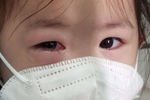 Tình hình dịch đau mắt đỏ tại Hà Nội và TP. HCM năm nay