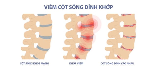 3 Phương pháp điều trị viêm cột sống dính khớp