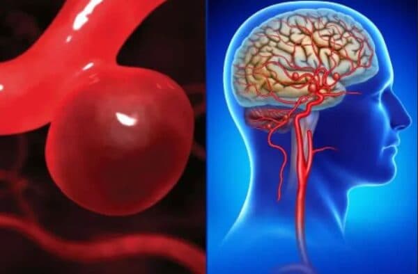 dự phòng đột quỵ