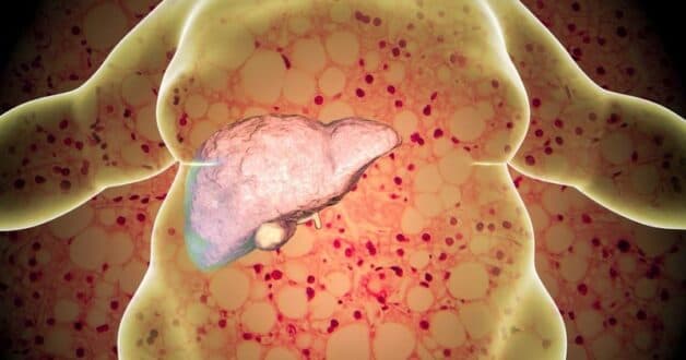 Triệu chứng gan nhiễm mỡ cấp độ 3 cụ thể, chứng tỏ chức năng gan đang bị ảnh hưởng nghiêm trọng