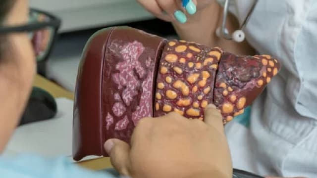 Gan to do gan nhiễm mỡ: Mối liên hệ, cách cải thiện