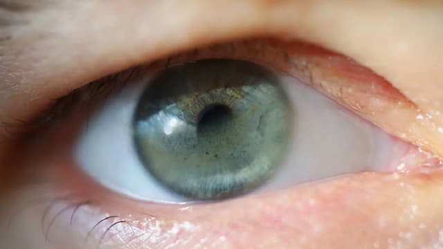 Giác mạc dải băng và những điều bạn cần biết