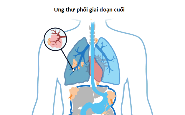 Giải đáp câu hỏi thường gặp về ung thư phổi giai đoạn di căn
