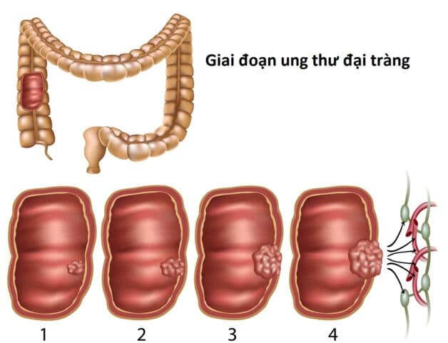 Các thông tin quan trọng về ung thư đại trực tràng