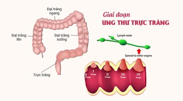 Tình trạng ung thư trực tràng khi di căn