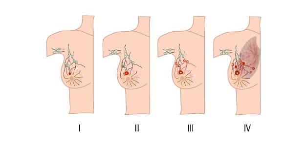 Bệnh ung thư vú giai đoạn 1 và cách điều trị