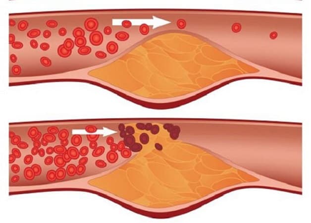 Cải thiện cholesterol tránh nguy cơ đột quỵ