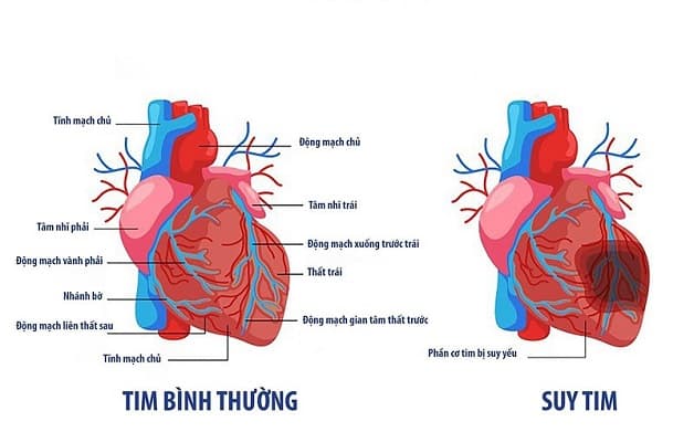 Hội chứng suy tim
