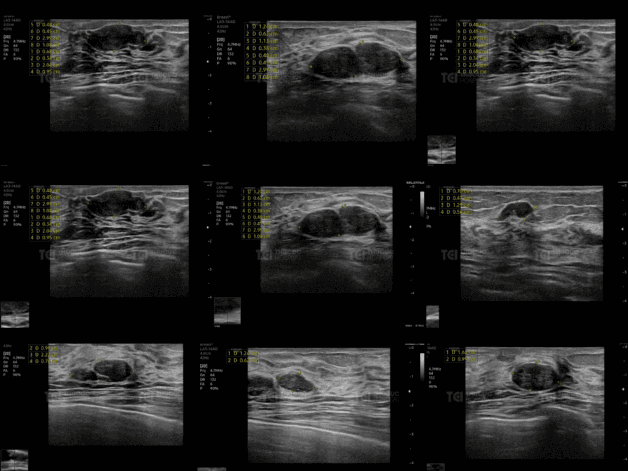 Hình ảnh siêu âm đa nhân tuyến vú của bệnh nhân K.L