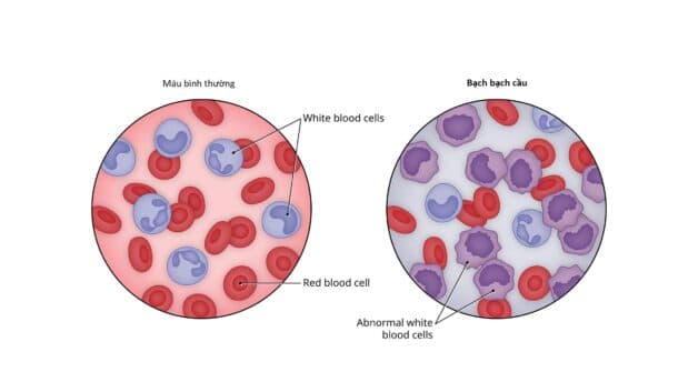 Tìm hiểu các nguyên nhân ung thư máu