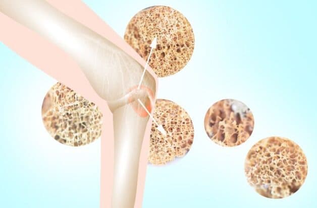 Bệnh loãng xương và cách điều trị với mục đích cải thiện mật độ xương