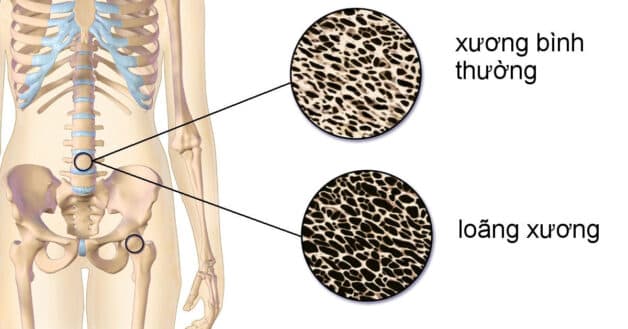 Tại sao khớp gối kêu? Khớp gối kêu lạo xạo cũng là dấu hiệu nhận biết bệnh loãng xương