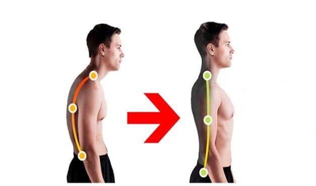 Dấu hiệu viêm cột sống dính khớp là lưng gù, dáng đi bất thường