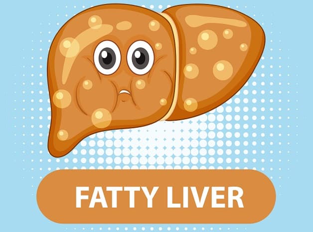 Gan nhiễm mỡ là gì, gồm những loại nào?