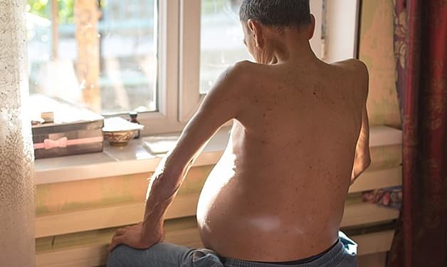 Xơ gan suy thận mạn thường xảy ra ở những đối tượng nào?