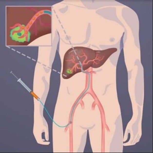 Tìm hiểu về phương pháp nút mạch hóa chất điều trị ung thư gan
