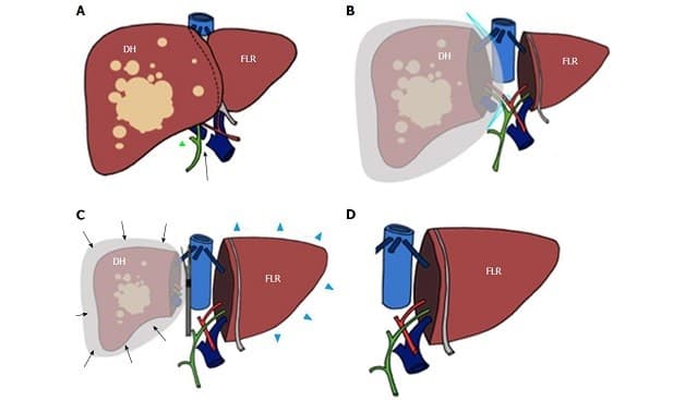 Điều trị ung thư gan biểu mô tế bào HCC giai đoạn 2