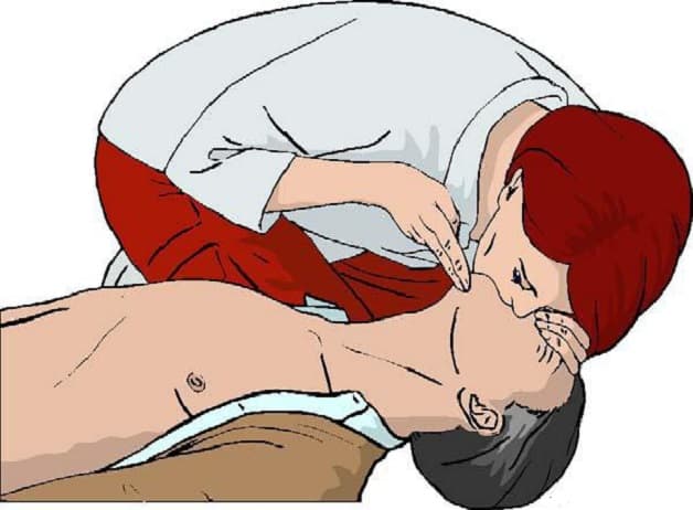 Cách sơ cứu đột quỵ thế nào nếu bệnh nhân ngừng thở