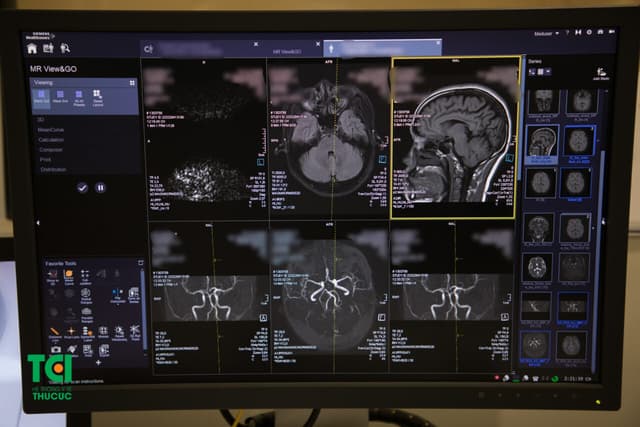 Cảnh giác trước nguy cơ đột quỵ do thoái hóa chất trắng não