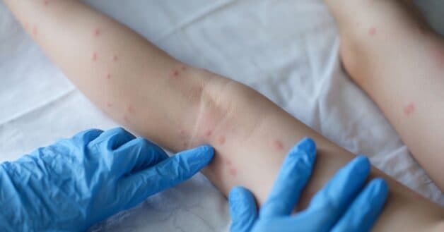 Trẻ mọc mụn nước trên nền các ban đỏ, mọc tập trung ở mặt trước và mọc ở thân, tay chân sau. 