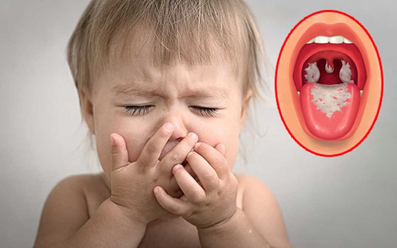 Trẻ em cần là đối tượng dễ bị bệnh bạch hầu