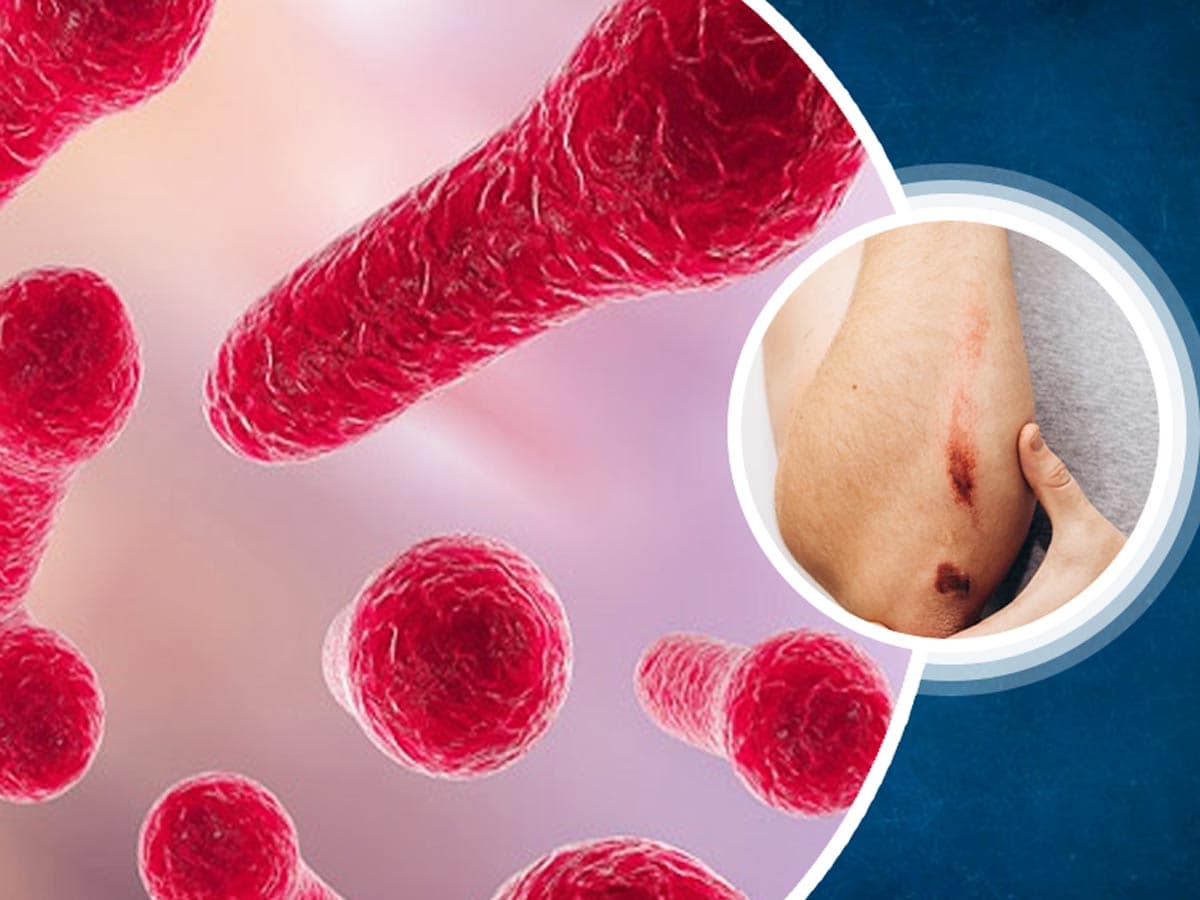 Vi khuẩn Clostridium tetani khi xâm nhập vào cơ thể sẽ tiết ra độc tố uốn ván gây bệnh