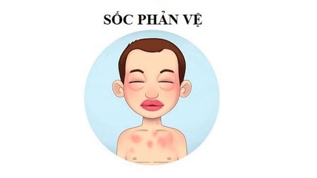 Sốc phản vệ là một tình trạng rất nghiêm trọng và cần được xử lý khẩn cấp