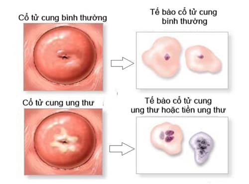 Tiền ung thư cổ tử cung