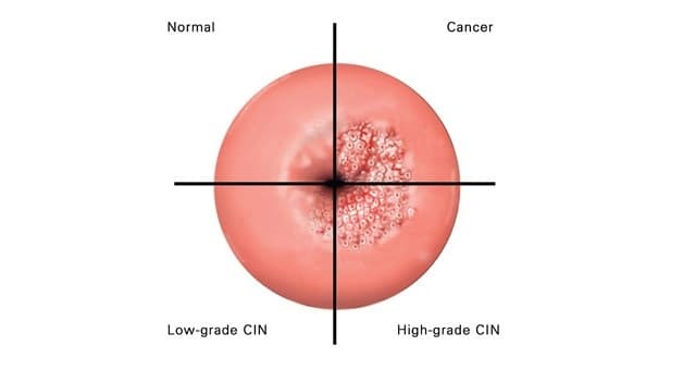 Tìm hiểu cách điều trị giai đoạn tiền ung thư cổ tử cung