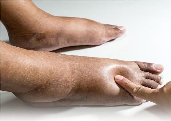 Triệu chứng phù do xơ gan biểu hiện ra sao?