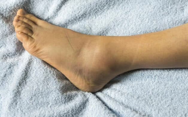 Ung thư bị phù chân và giải pháp chăm sóc cho người bệnh ung thư gan